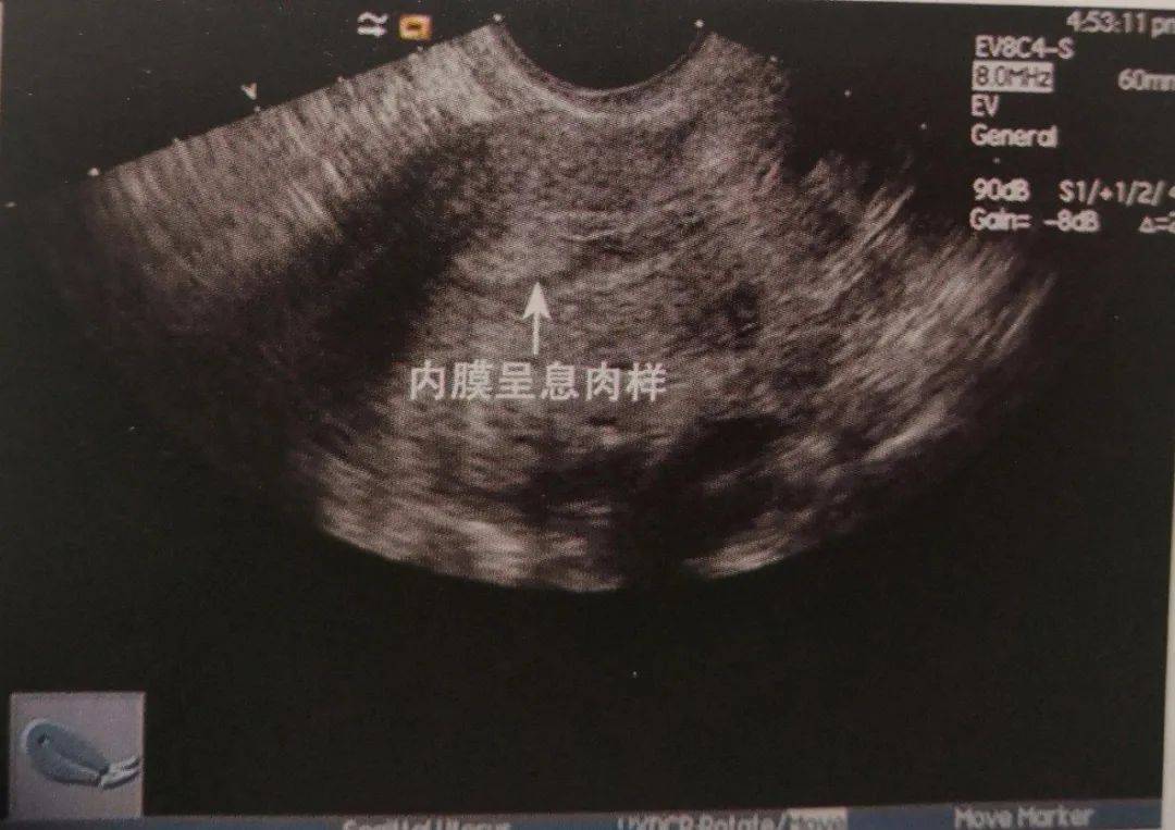 原创子宫内膜不均匀怎么办呢