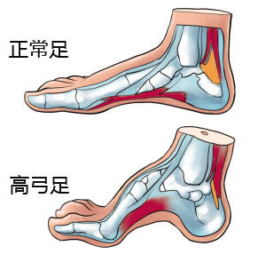 四种类型的高弓足别等严重了才发现