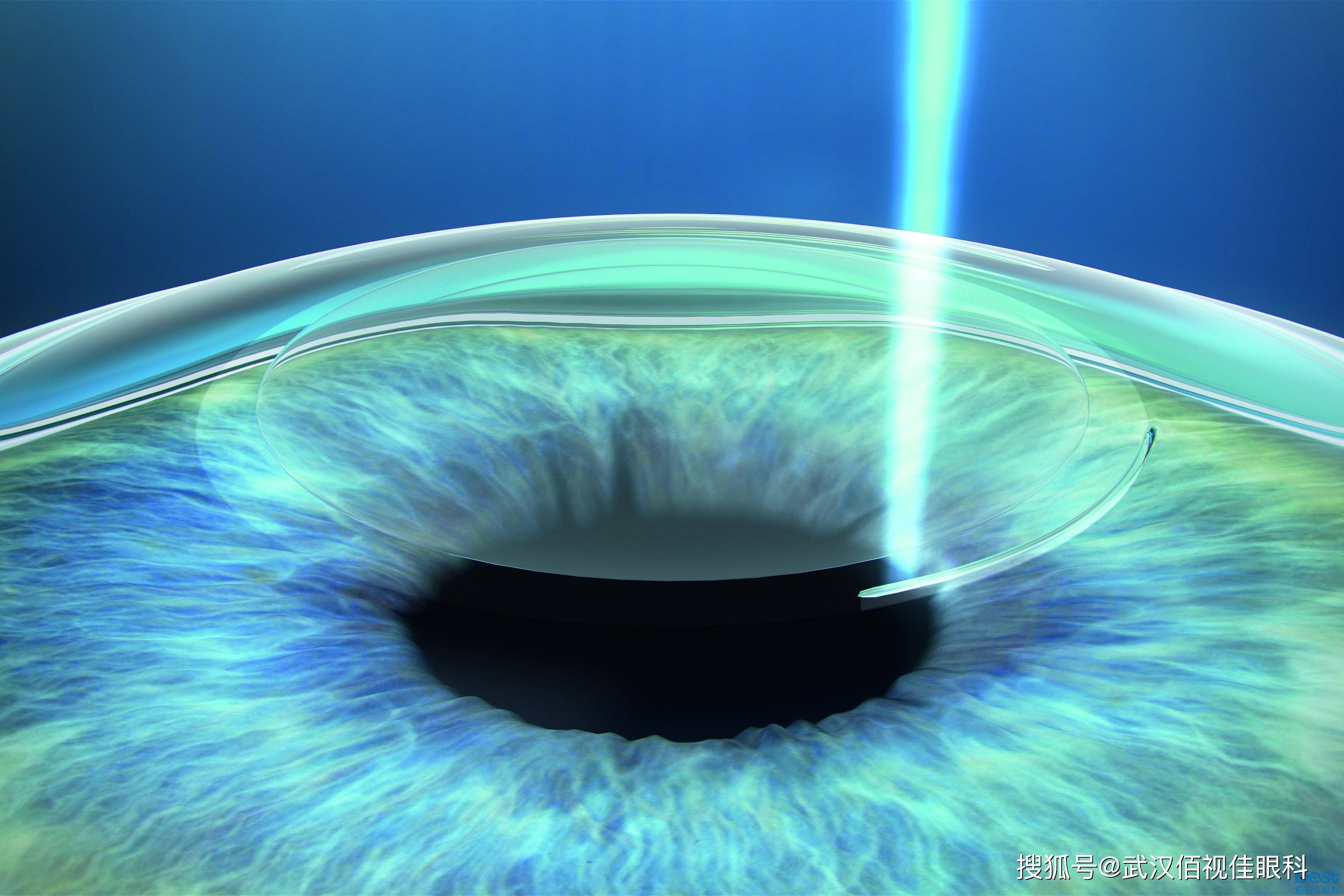 目前比较常见的近视矫正手术主要有全飞秒(个性化)半飞秒,全激光,icl