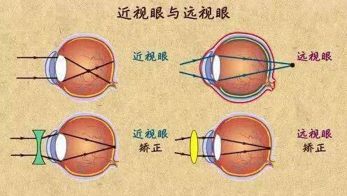 但和近视不一样, 远视指平行光束经过调节放松的眼球折射后成像于