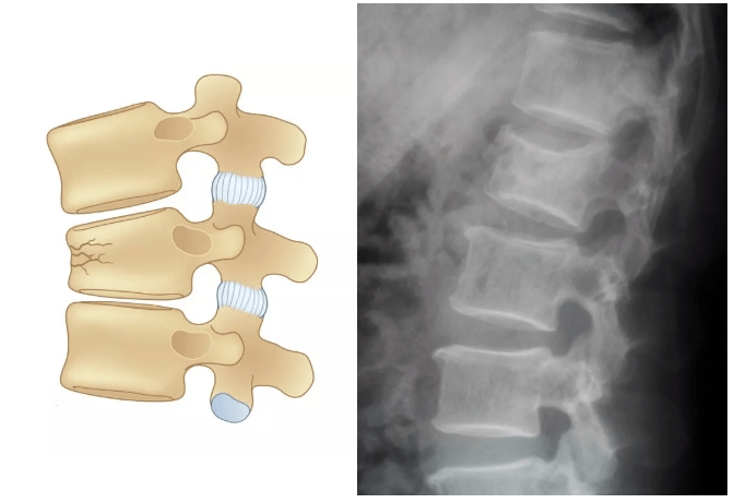胸腰椎骨质疏松性压缩骨折小科普