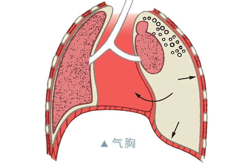 百草益寿:"肺气炸了"不是戏言,爱生气的人都来看看
