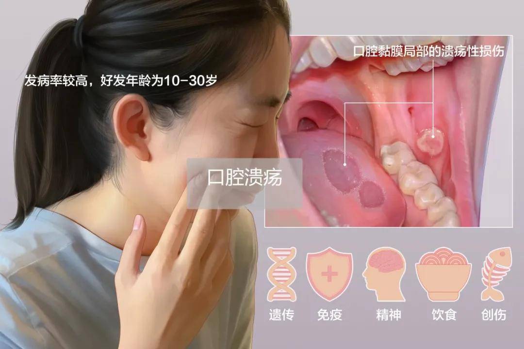 阿弗他溃疡诊疗指南(实行)》显示,10% - 25%的人群患有复发性口腔溃疡