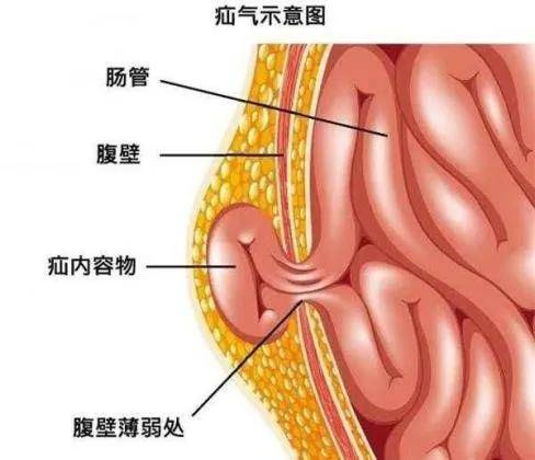 什么是疝气?