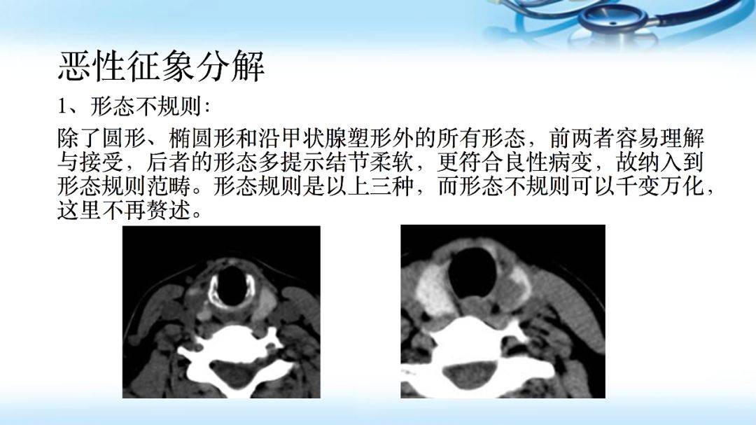 甲状腺结节ct影像解析思路