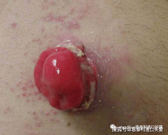 造口周围皮肤出现红痒,肿痛怎么办?