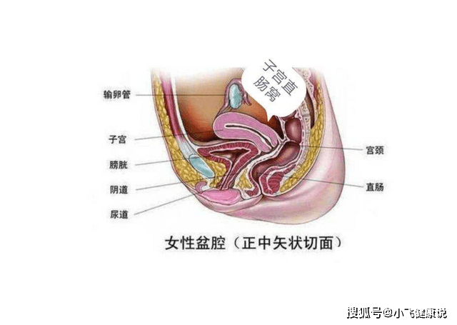 原创盆腔积液怎么办尽量掌握好这3种疗法或可有效消除盆腔积液