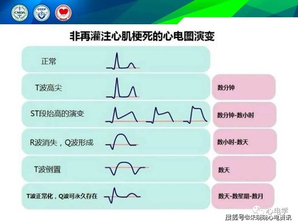 常见心血管疾病基本心电图识别