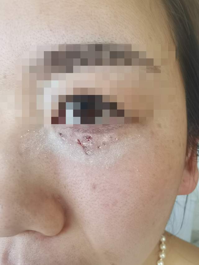 分享一个不用激光,纯技术操作去除汗管瘤的案例