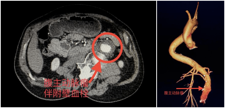 术前主动脉cta提示腹主动脉瘤伴附壁血栓形成经人介绍,白大爷和家属