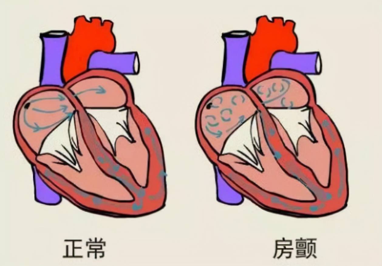 房颤是心脏病吗?对人体有哪些危害?医生给你解疑答惑