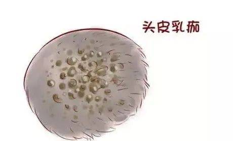 2 头皮乳痂是怎么形成的? 遗传原因和宝宝的饮食习惯都可能引起乳痂.