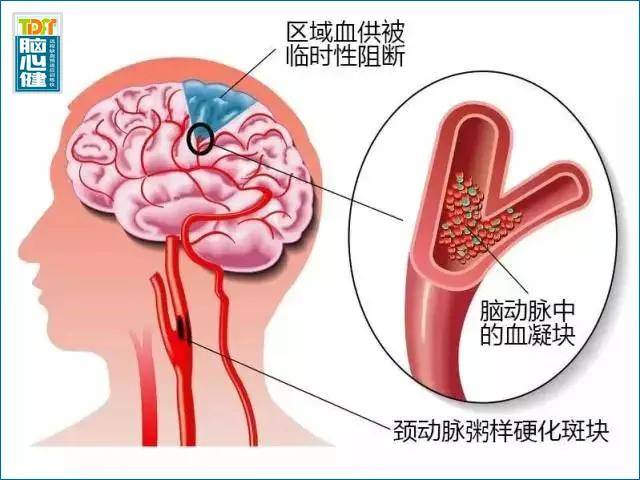 如果引起脑组织明显的损伤,或脑梗塞的部位比较关键,容易导致意识