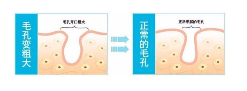 毛孔粗大的同时也会将皮肤表面的问题一并放大.