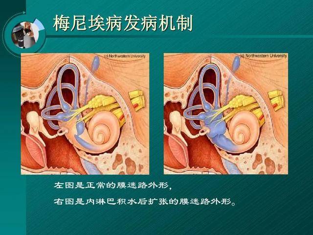 原创结石姐的梅尼埃病你听说过吗