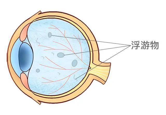 玻璃体混浊是什么?严重吗?