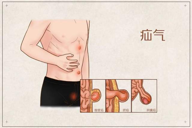 腹壁疝俗称疝气,是常见的外科疾病,由于多数患者患病时并无过多不适