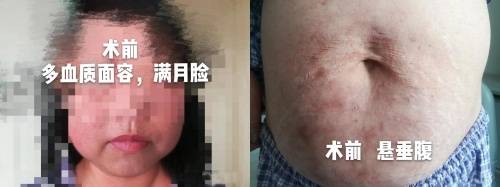 三博脑科满月脸水桶腰变身巴掌脸小蛮腰这个手术如魔法般堪比整容