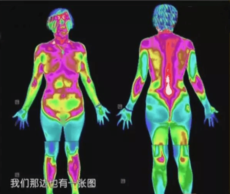 红外热成像仪的医学应用,不健康的人体热像图是怎样的?