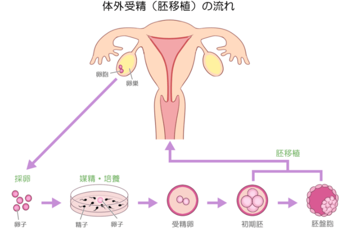 体外受精胚胎移植流程~收集的卵子和精子结合制成受精卵并转移到子宫