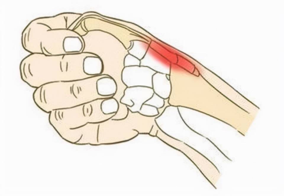 有腱鞘炎别慌,跟我这样做