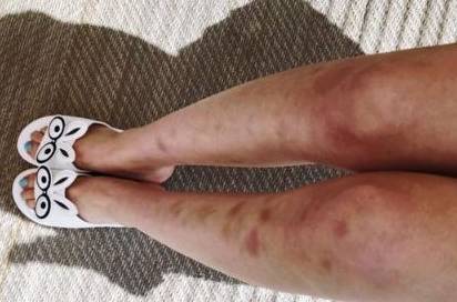 原创为何轻轻一碰,身体就容易出现一些淤青?多半与它有关