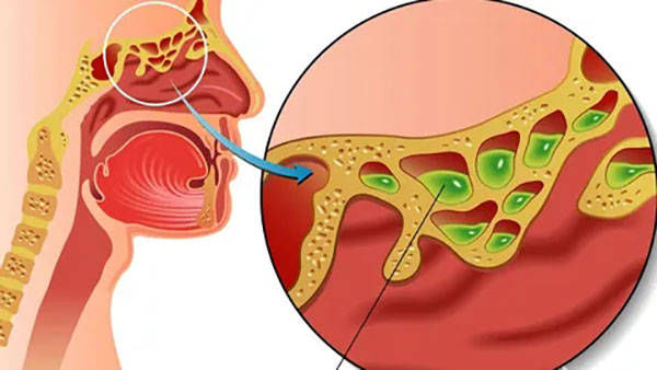 咽喉异物感病因咽部疾病各类咽炎,慢性扁桃体炎,扁桃体的结石,息肉