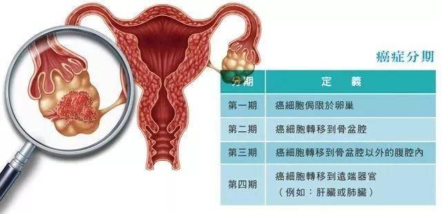 为什么卵巢癌一发现就是晚期?五种情况要警惕!