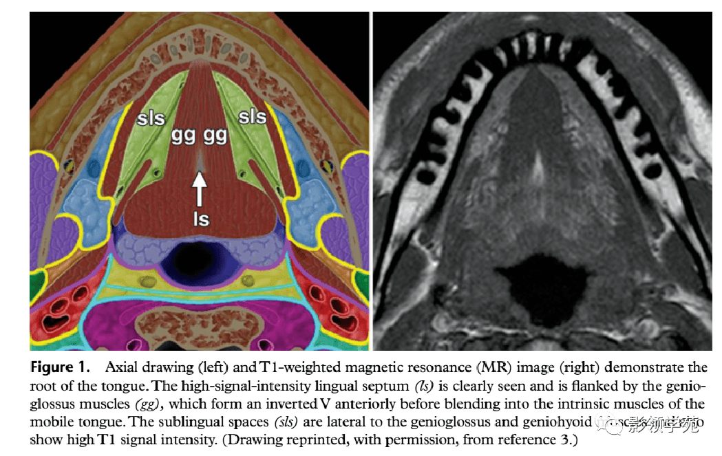舌口底影像解剖及常见疾病影像诊断