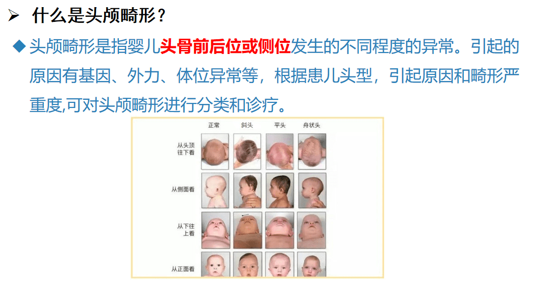 新生儿先天性头颅畸形头颅矫正