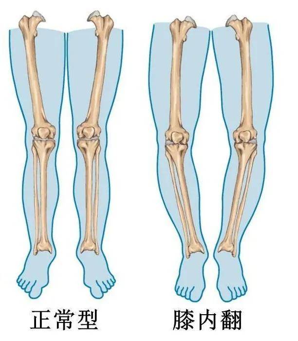 o型腿(膝内翻)分体分级和康复训练_膝盖_安阳_医疗