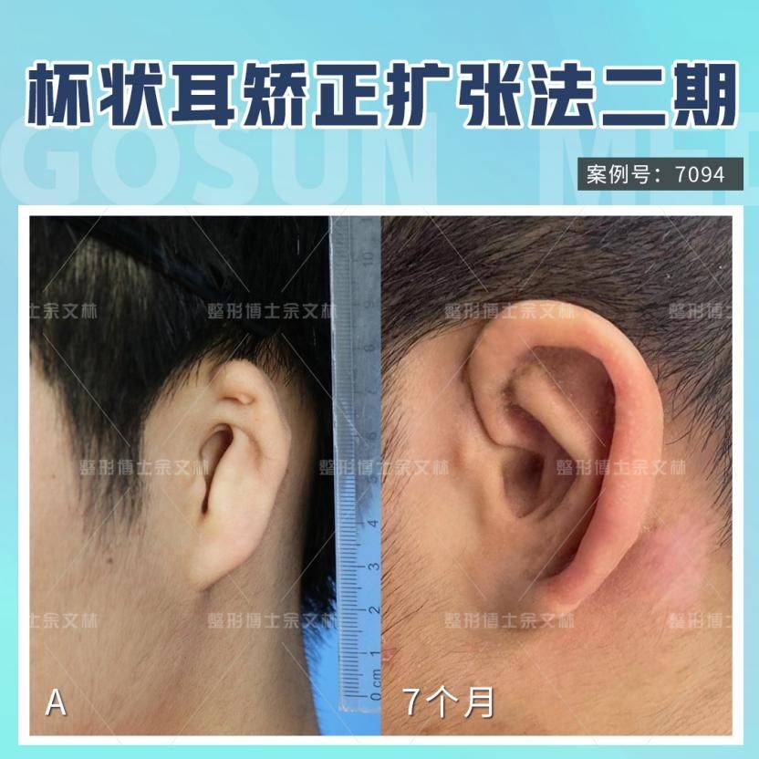 杯状耳有必要矫正吗?杯状耳的手术修复方法?_耳廓