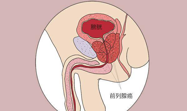 原创被前列腺癌缠上的男性大多数喜欢吃2类食物其中有没有你