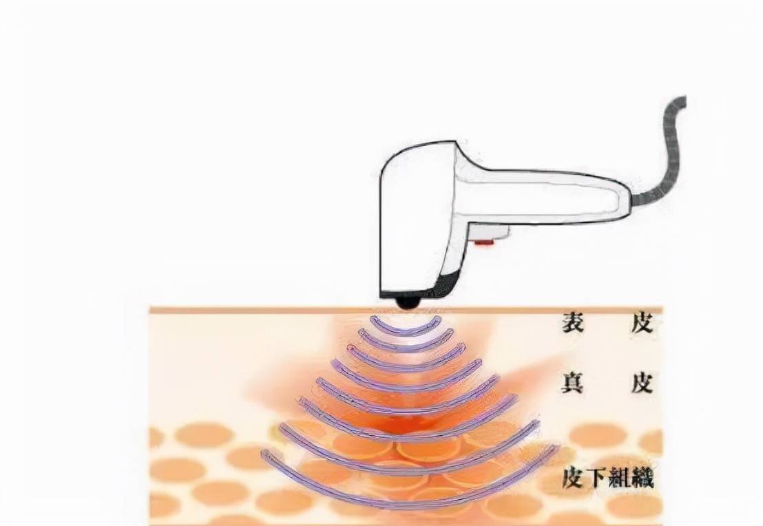 建议收藏:热拉提和fotona4d哪个效果更好,功效原理有?