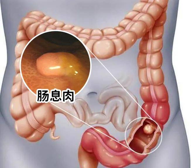 平均每五个人中就有一个人有肠道息肉