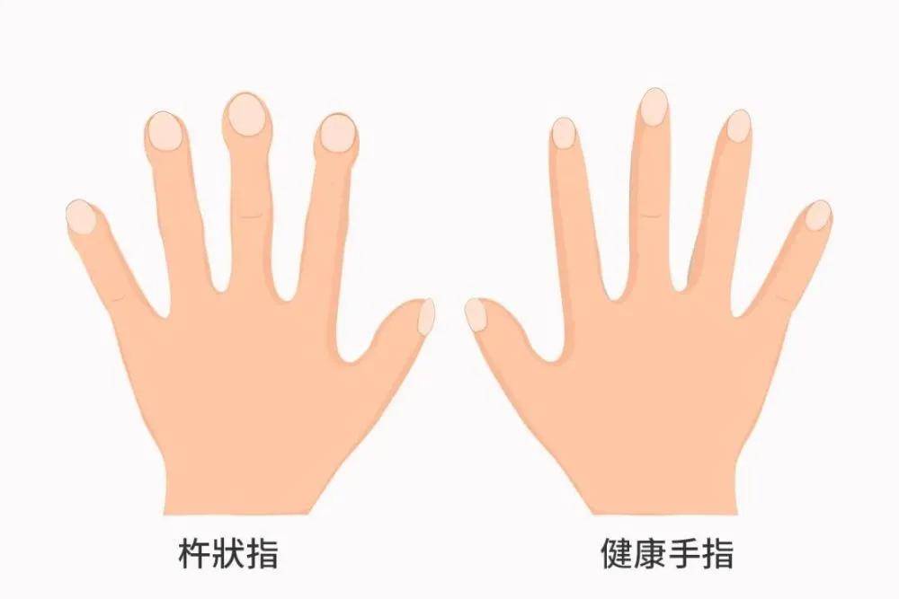 肺癌患者手指的这种变化临床上较为多见,主要表现为杵状指(趾),骨关节