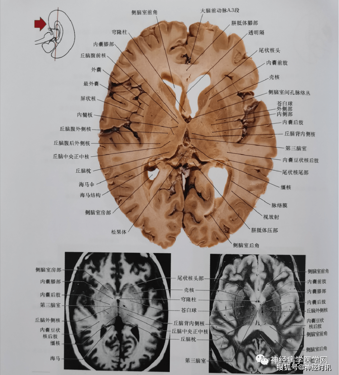 临床神经解剖图谱(断层影像 切片)_平面_丘脑_脑桥
