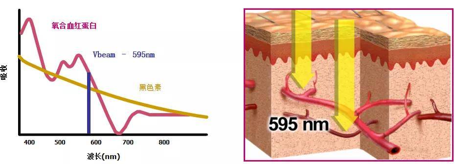 摆脱高原红去除红血丝看看vbeam595nm脉冲染料激光