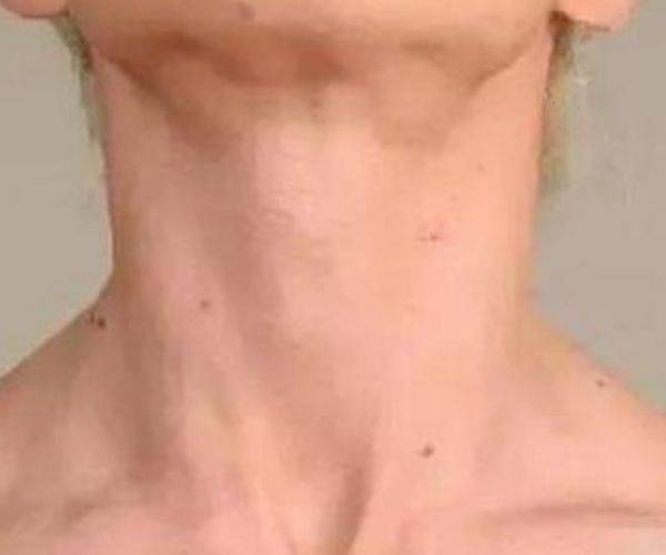 脖子上为什么会长肉疙瘩可能和3种原因有关了解下