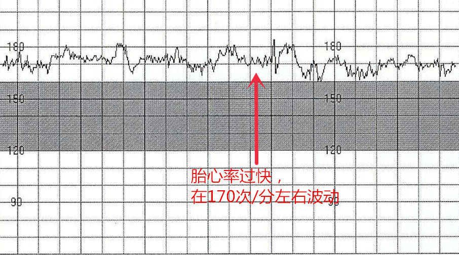 原创孕晚期做胎心监护很重要这些注意事项准妈妈要牢记