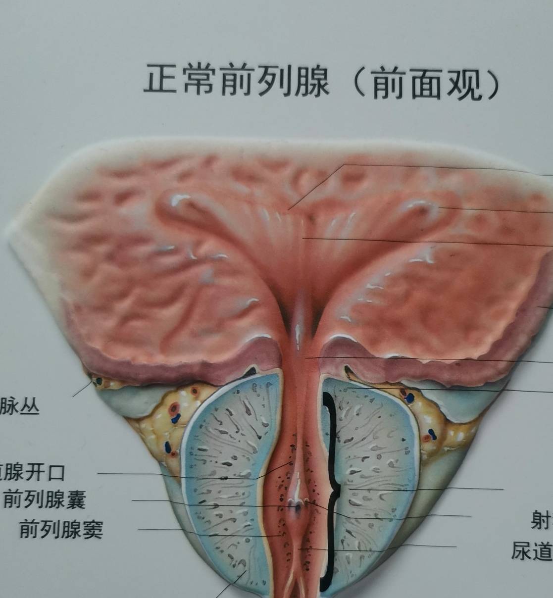 "后有虎狼"指膀胱内的尿液也可能导致前列腺腺管反流