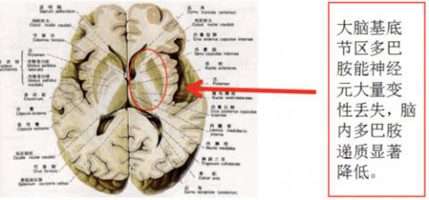 协同作用的结果;从神经科学角度来说,帕金森病本质上是人脑中某个区域