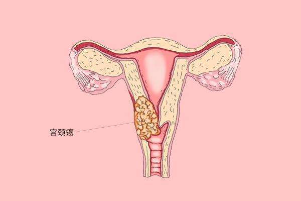 提醒4145岁之间的女性宫颈癌的高发阶段要注意身体3个异常