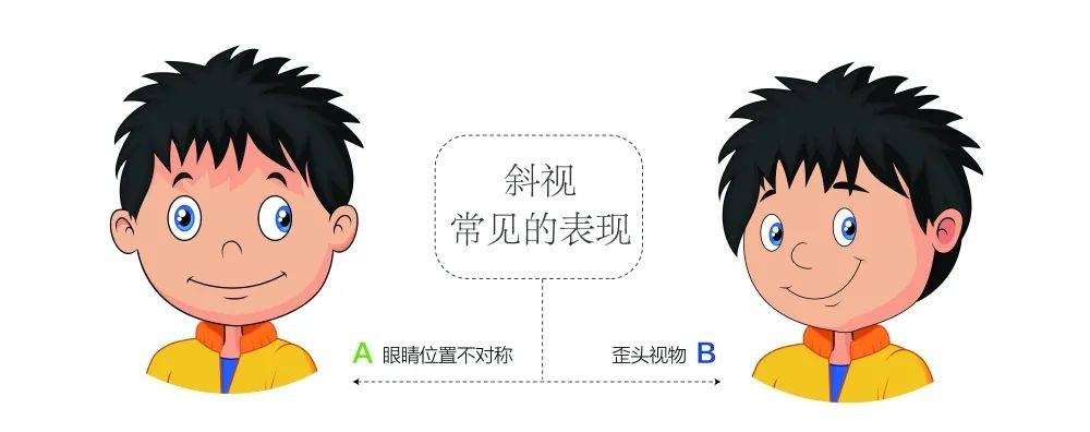 歪头斜眼是大问题孩子斜视一定要尽早治疗