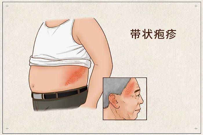 原创中老年易患的蛇缠腰有救了带状疱疹疫苗已上市只需2针