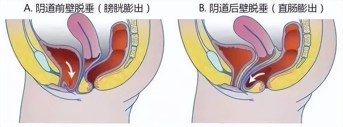 生了宝宝,我就阴道壁膨出了_治疗_膀胱_肌肉