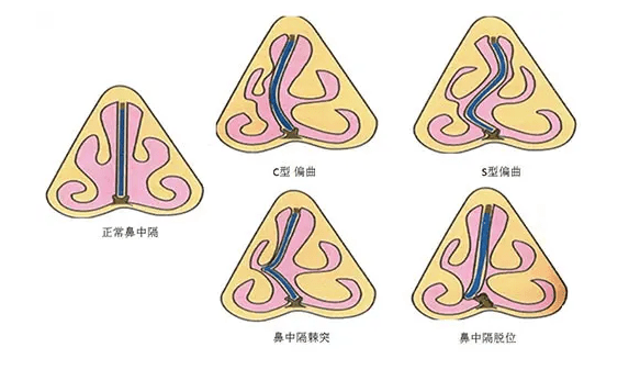 鼻中隔偏曲可是拖不得!_影响_鼻子_鼻窦