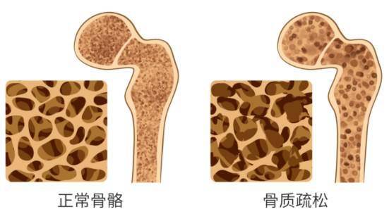 若何预防骨量松散？五个留意事项教给你，庇护您的骨骼安康！