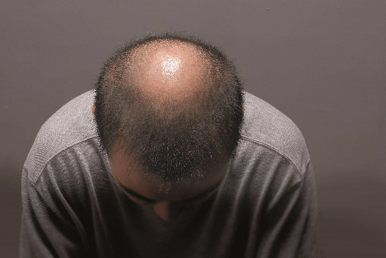 45岁以后，头发会越来越稀疏，甚至秃顶，不仅会影响人的外在美感，还会