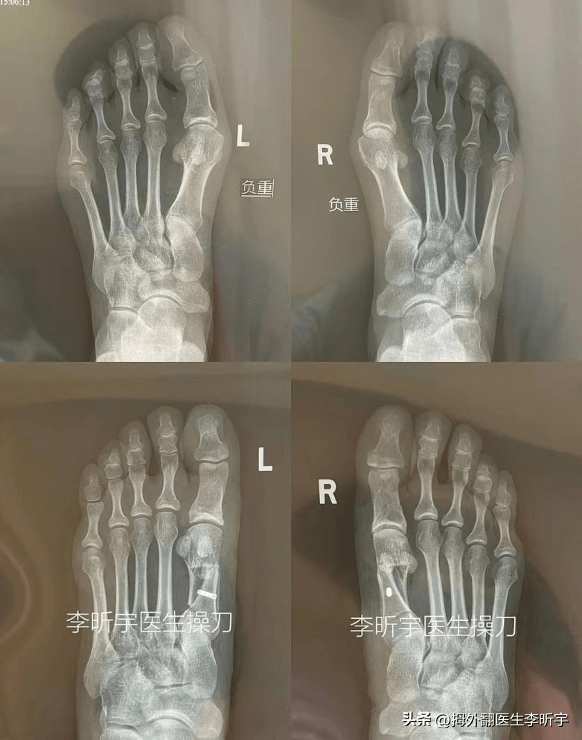 当晓得“拇外翻”是一种病，就决心要把它做掉，不想以后懊悔！